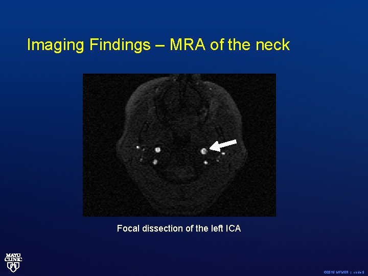 Imaging Findings – MRA of the neck Focal dissection of the left ICA ©