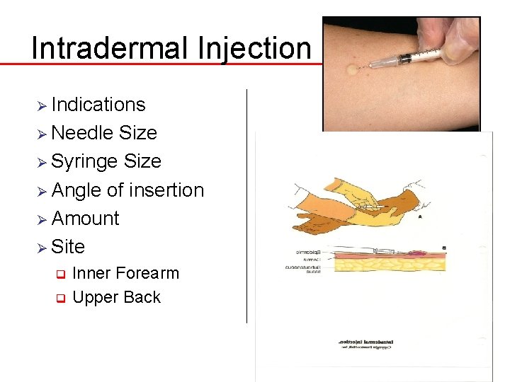 Intradermal Injection Ø Indications Ø Needle Size Ø Syringe Size Ø Angle of insertion