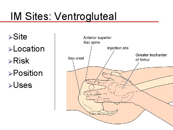 IM Sites: Ventrogluteal ØSite ØLocation ØRisk ØPosition ØUses 