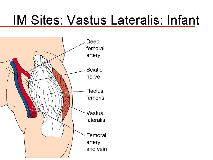 IM Sites: Vastus Lateralis: Infant 