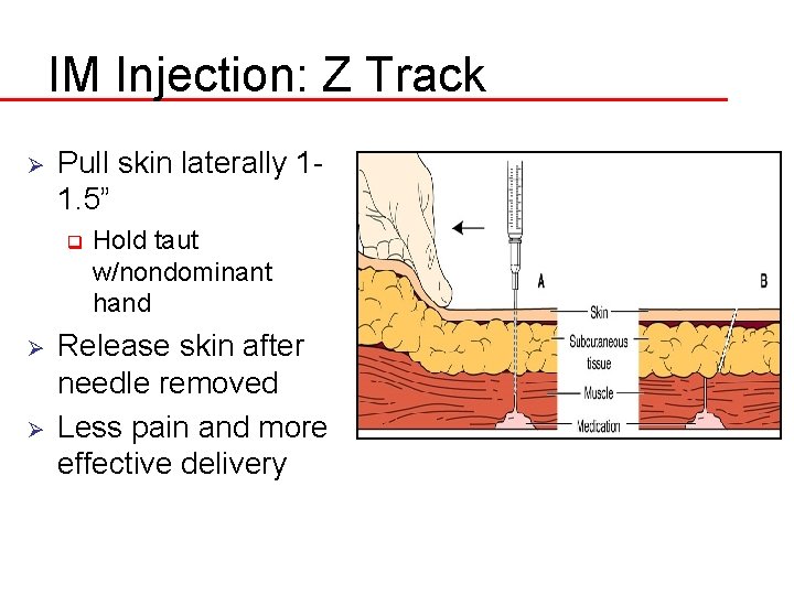 IM Injection: Z Track Ø Pull skin laterally 11. 5” q Ø Ø Hold