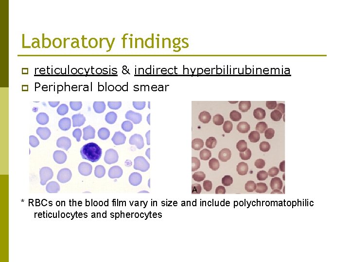 Laboratory findings p p reticulocytosis & indirect hyperbilirubinemia Peripheral blood smear * RBCs on