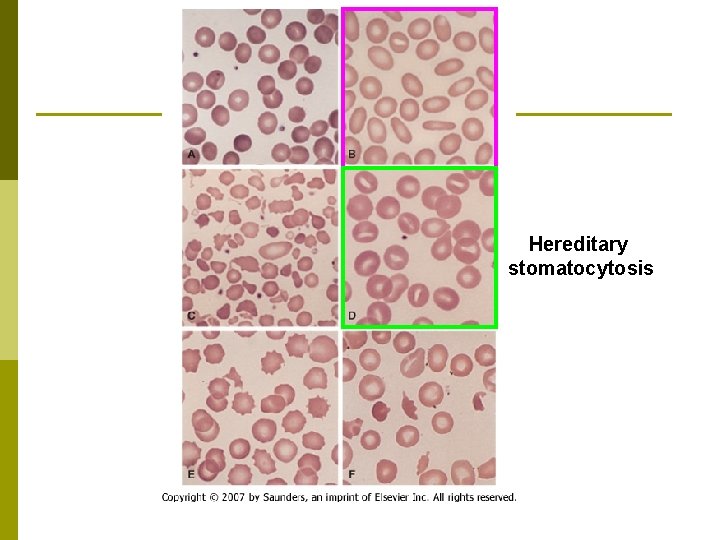 Hereditary stomatocytosis 
