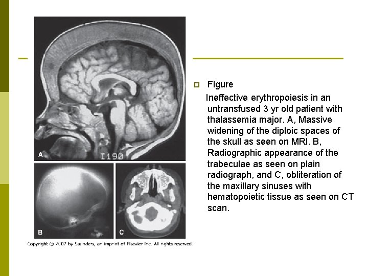 p Figure Ineffective erythropoiesis in an untransfused 3 yr old patient with thalassemia major.