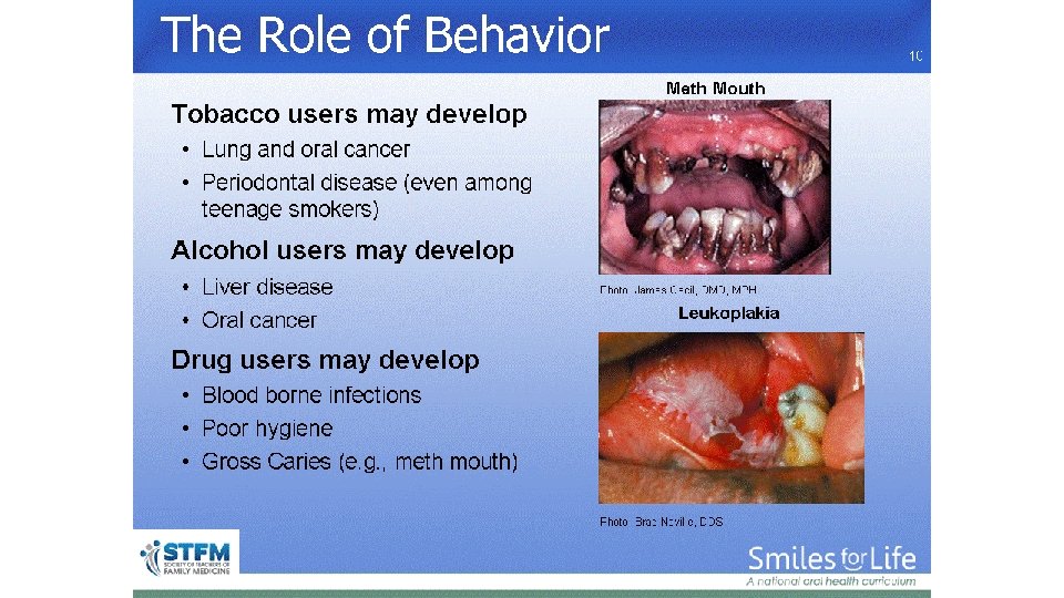 The Role of Behavior 10 Meth Mouth Photo: James Cecil, DMD, MPH Leukoplakia Photo: