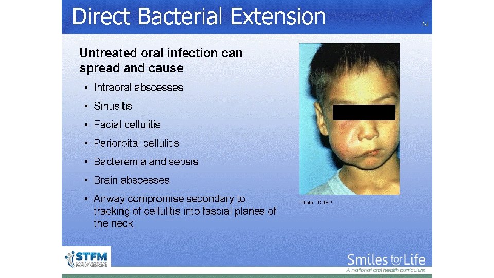 Direct Bacterial Extension Photo: ICOHP 14 