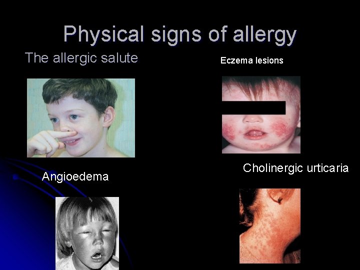 Physical signs of allergy The allergic salute Angioedema Eczema lesions Cholinergic urticaria Physical signs of allergy The allergic salute Angioedema Eczema lesions Cholinergic urticaria