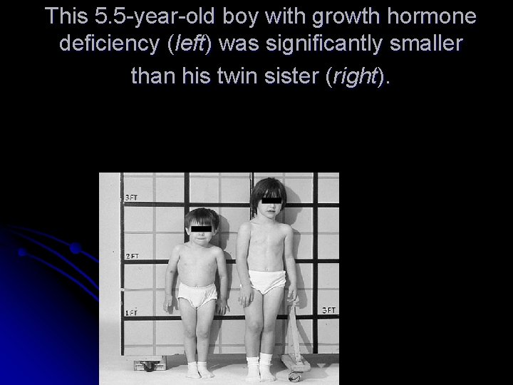 This 5. 5 -year-old boy with growth hormone deficiency (left) was significantly smaller than This 5. 5 -year-old boy with growth hormone deficiency (left) was significantly smaller than