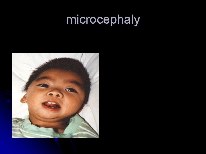 microcephaly microcephaly