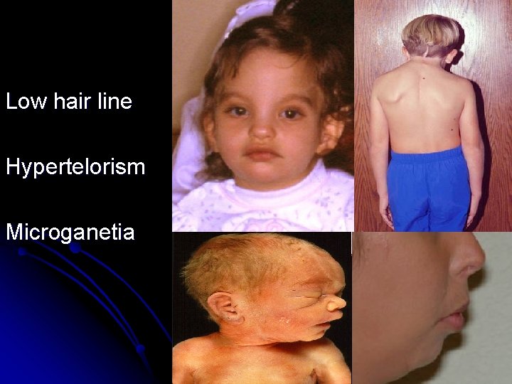 Low hair line Hypertelorism Microganetia Low hair line Hypertelorism Microganetia