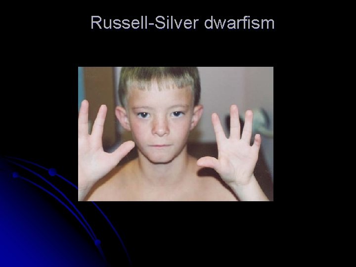 Russell-Silver dwarfism Russell-Silver dwarfism