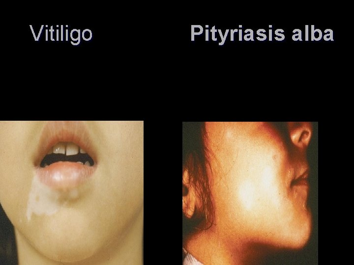 Vitiligo Pityriasis alba Vitiligo Pityriasis alba