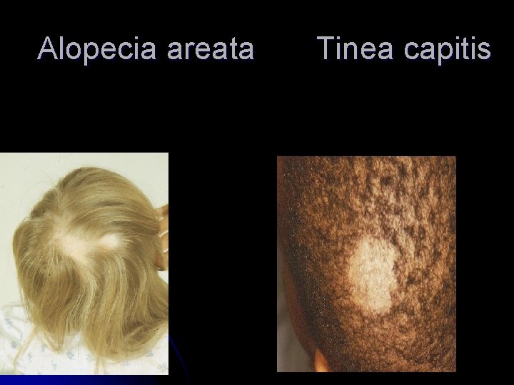 Alopecia areata Tinea capitis Alopecia areata Tinea capitis