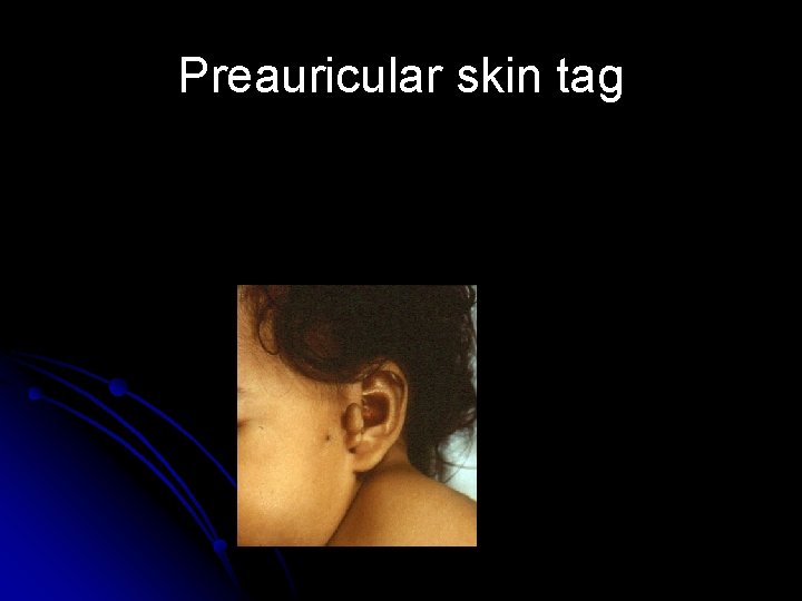 Preauricular skin tag Preauricular skin tag