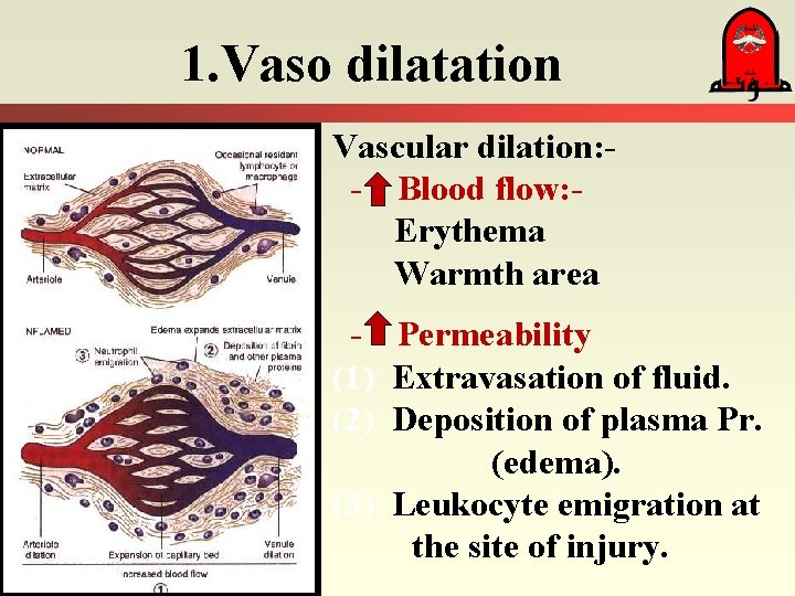 1. Vaso dilatation Vascular dilation: - Blood flow: Erythema Warmth area - Permeability (1) 1. Vaso dilatation Vascular dilation: - Blood flow: Erythema Warmth area - Permeability (1)