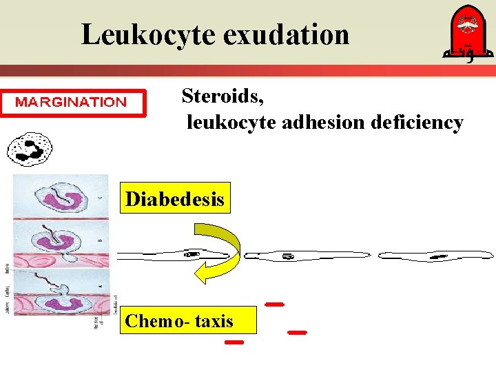 Leukocyte exudation Steroids, leukocyte adhesion deficiency Diabedesis Chemo- taxis Leukocyte exudation Steroids, leukocyte adhesion deficiency Diabedesis Chemo- taxis