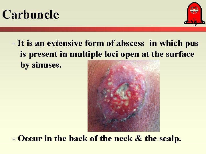 Carbuncle - It is an extensive form of abscess in which pus is present Carbuncle - It is an extensive form of abscess in which pus is present