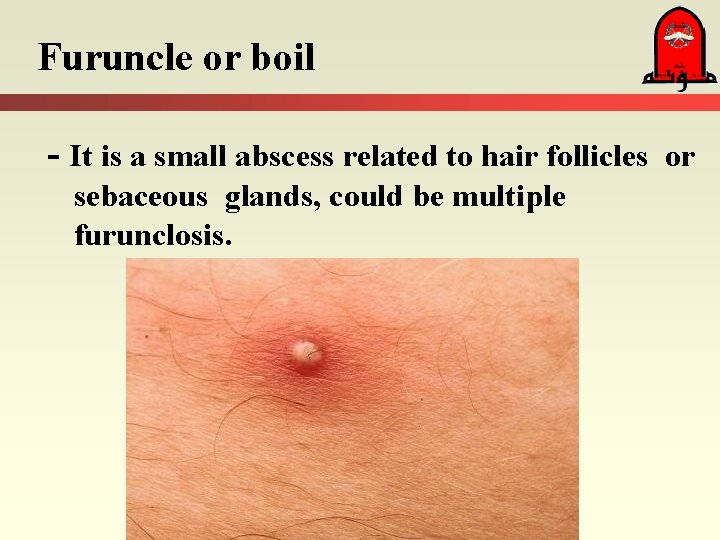 Furuncle or boil - It is a small abscess related to hair follicles sebaceous Furuncle or boil - It is a small abscess related to hair follicles sebaceous