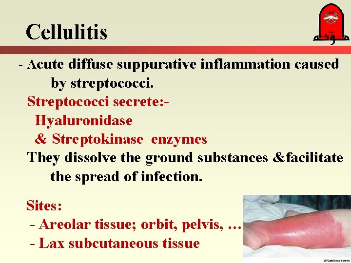 Cellulitis - Acute diffuse suppurative inflammation caused by streptococci. Streptococci secrete: Hyaluronidase & Streptokinase Cellulitis - Acute diffuse suppurative inflammation caused by streptococci. Streptococci secrete: Hyaluronidase & Streptokinase