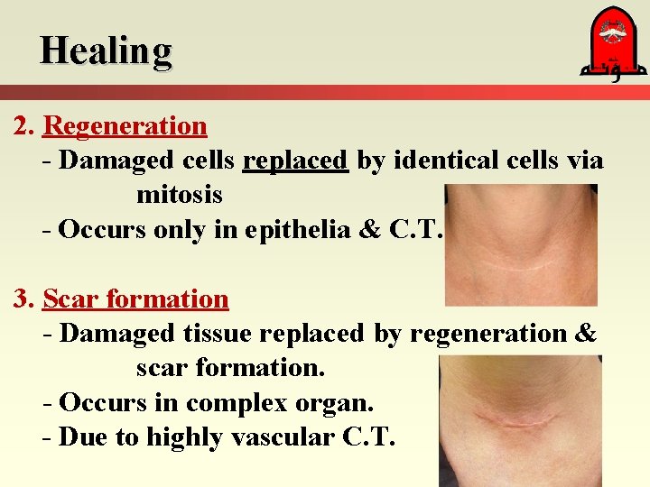 Healing 2. Regeneration - Damaged cells replaced by identical cells via mitosis - Occurs Healing 2. Regeneration - Damaged cells replaced by identical cells via mitosis - Occurs