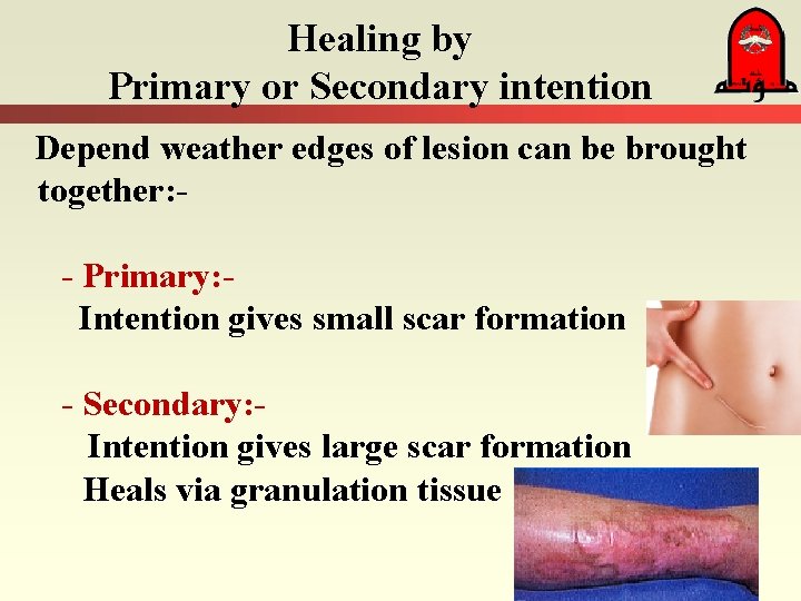 Healing by Primary or Secondary intention Depend weather edges of lesion can be brought Healing by Primary or Secondary intention Depend weather edges of lesion can be brought