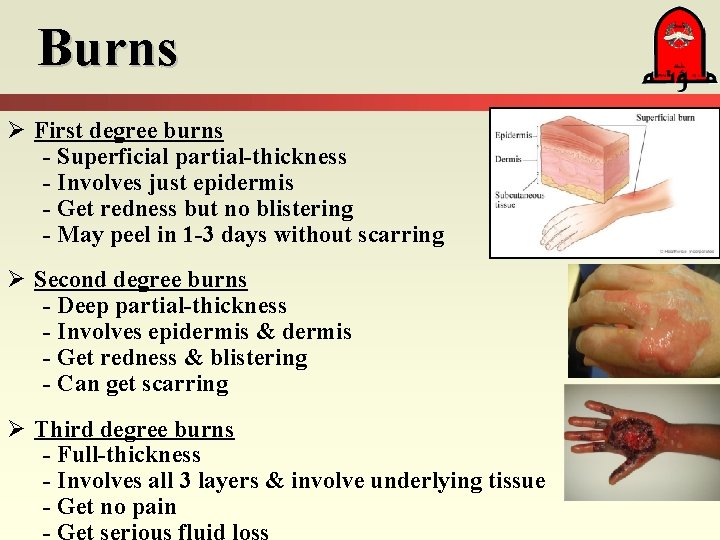 Burns Ø First degree burns - Superficial partial-thickness - Involves just epidermis - Get Burns Ø First degree burns - Superficial partial-thickness - Involves just epidermis - Get
