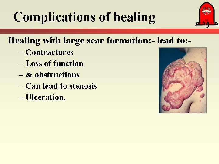 Complications of healing Healing with large scar formation: - lead to: – Contractures – Complications of healing Healing with large scar formation: - lead to: – Contractures –