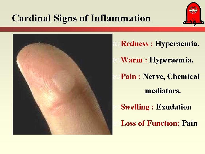 Cardinal Signs of Inflammation Redness : Hyperaemia. Warm : Hyperaemia. Pain : Nerve, Chemical Cardinal Signs of Inflammation Redness : Hyperaemia. Warm : Hyperaemia. Pain : Nerve, Chemical