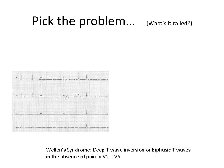 Pick the problem… (What’s it called? ) Wellen’s Syndrome: Deep T-wave inversion or biphasic