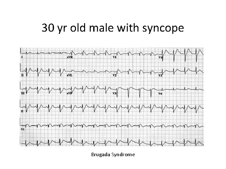 30 yr old male with syncope Brugada Syndrome 