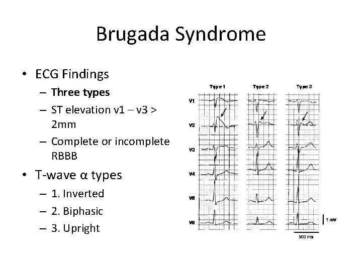 Brugada Syndrome • ECG Findings – Three types – ST elevation v 1 –