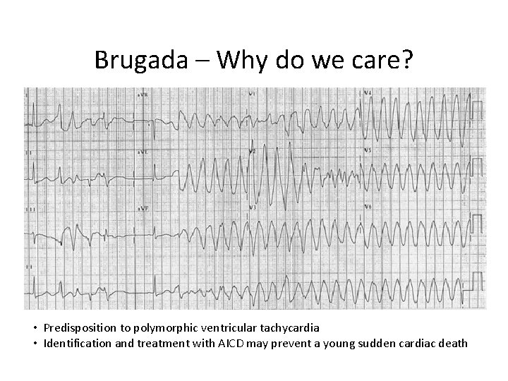 Brugada – Why do we care? • Predisposition to polymorphic ventricular tachycardia • Identification