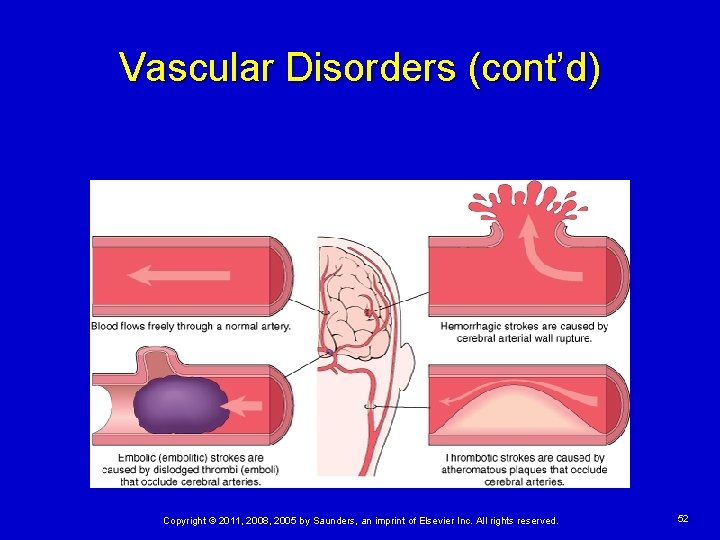 Vascular Disorders (cont’d) Copyright © 2011, 2008, 2005 by Saunders, an imprint of Elsevier