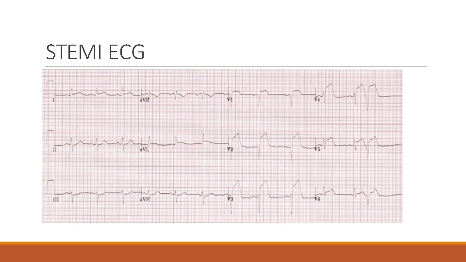 STEMI ECG 