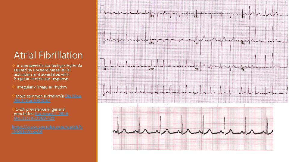 Atrial Fibrillation v A supraventricular tachyarrhythmia caused by uncoordinated atrial activation and associated with