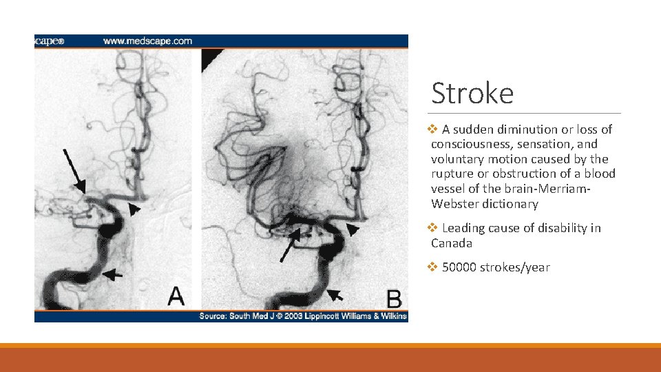 Stroke v A sudden diminution or loss of consciousness, sensation, and voluntary motion caused