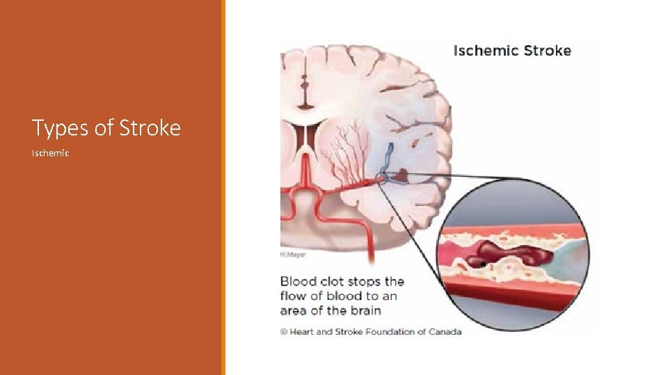 Types of Stroke Ischemic 