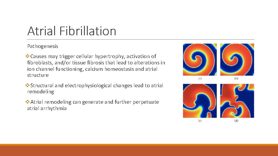 Atrial Fibrillation Pathogenesis v. Causes may trigger cellular hypertrophy, activation of fibroblasts, and/or tissue