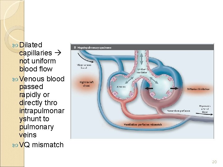  Dilated capillaries not uniform blood flow Venous blood passed rapidly or directly thro