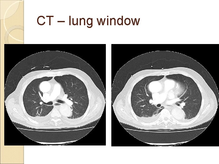 CT – lung window 