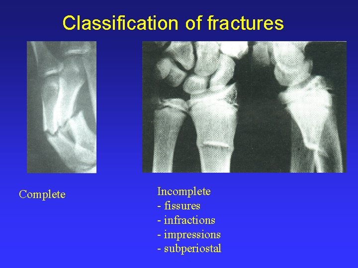 Classification of fractures Complete Incomplete - fissures - infractions - impressions - subperiostal 