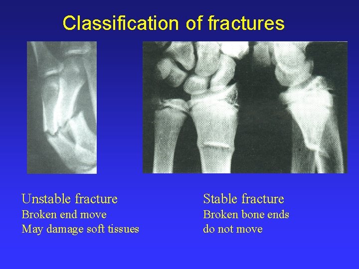Classification of fractures Unstable fracture Stable fracture Broken end move May damage soft tissues