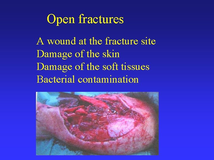 Open fractures A wound at the fracture site Damage of the skin Damage of