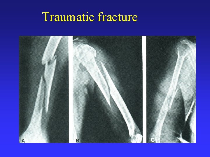 Traumatic fracture 