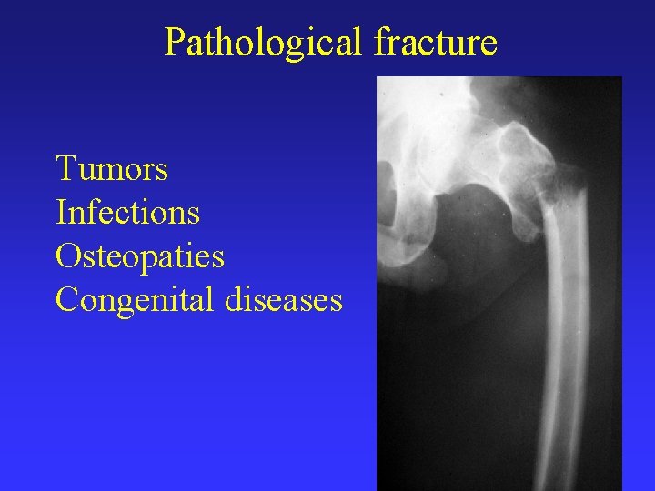 Pathological fracture Tumors Infections Osteopaties Congenital diseases 