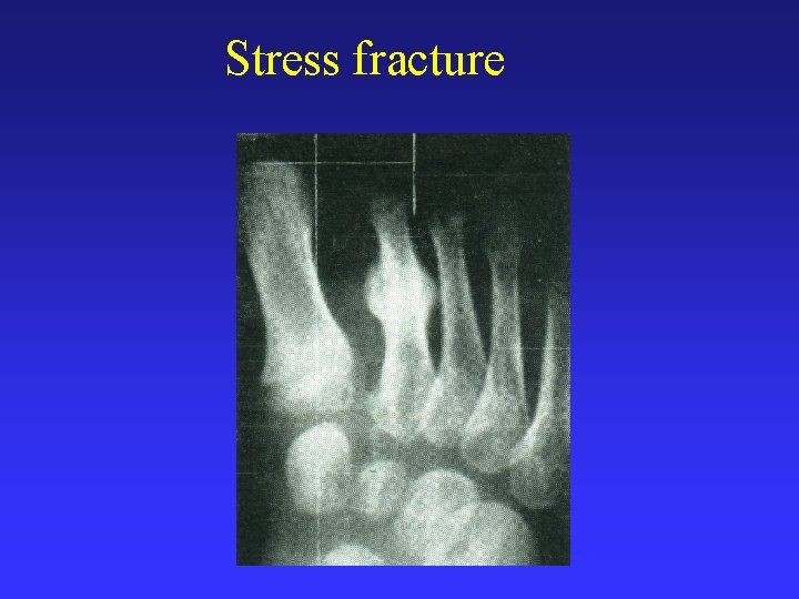 Stress fracture 