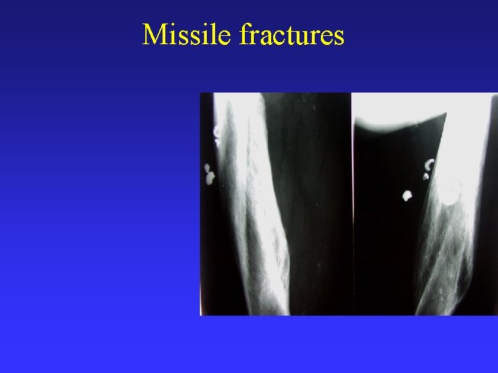 Missile fractures 
