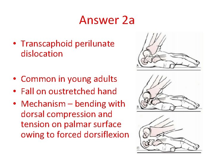 Answer 2 a • Transcaphoid perilunate dislocation • Common in young adults • Fall