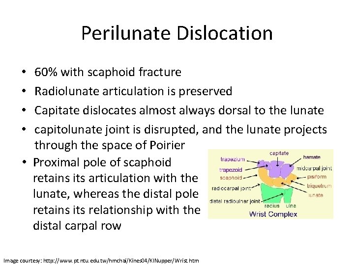 Perilunate Dislocation 60% with scaphoid fracture Radiolunate articulation is preserved Capitate dislocates almost always