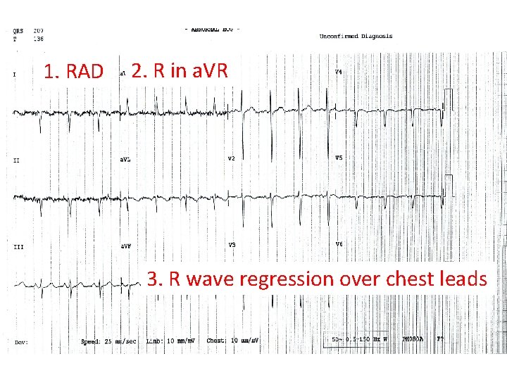 1. RAD 2. R in a. VR 3. R wave regression over chest leads